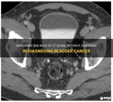 Will a CT Scan Show Bladder Cancer? Exploring the Intersection of Technology and Human Curiosity